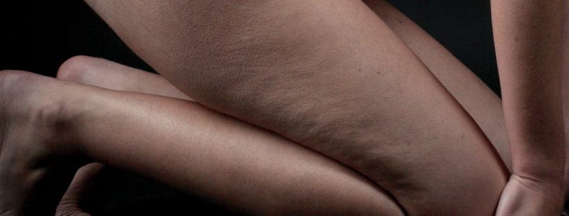 woman with cellulite